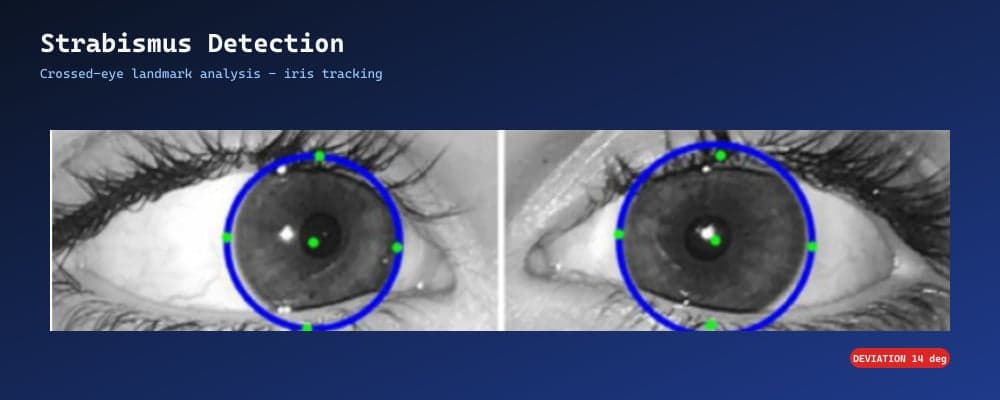 Crossed-Eye (Strabismus) Detection